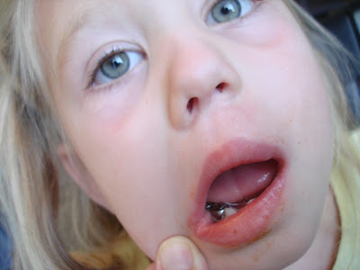 Cold sore remedy for baby jaundice
