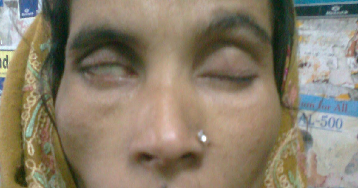 the blog of koushik tripathy BELL'S phenomenon in BELL'S palsy