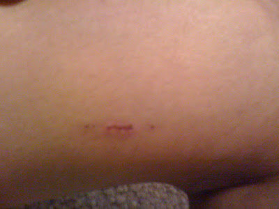 Pick Scabs