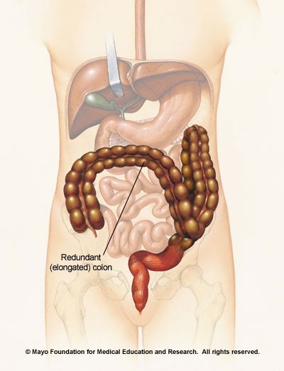 Live Happy Redundant Colon