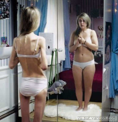 CAUSAS DE LA ANOREXIA NERVIOSA causas de la bulimia. CAUSAS DE LA ANOREXIA NERVIOSA