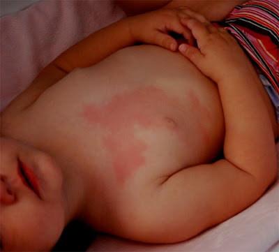 heat rashes in babies. to think it#39;s a heat rash.