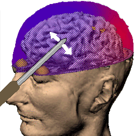 Жуть! Лоботамия! Когда то так лечили.. Academic+lobotomy