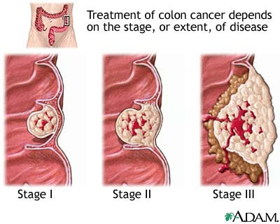 Colon Cancer Symptoms Pictures