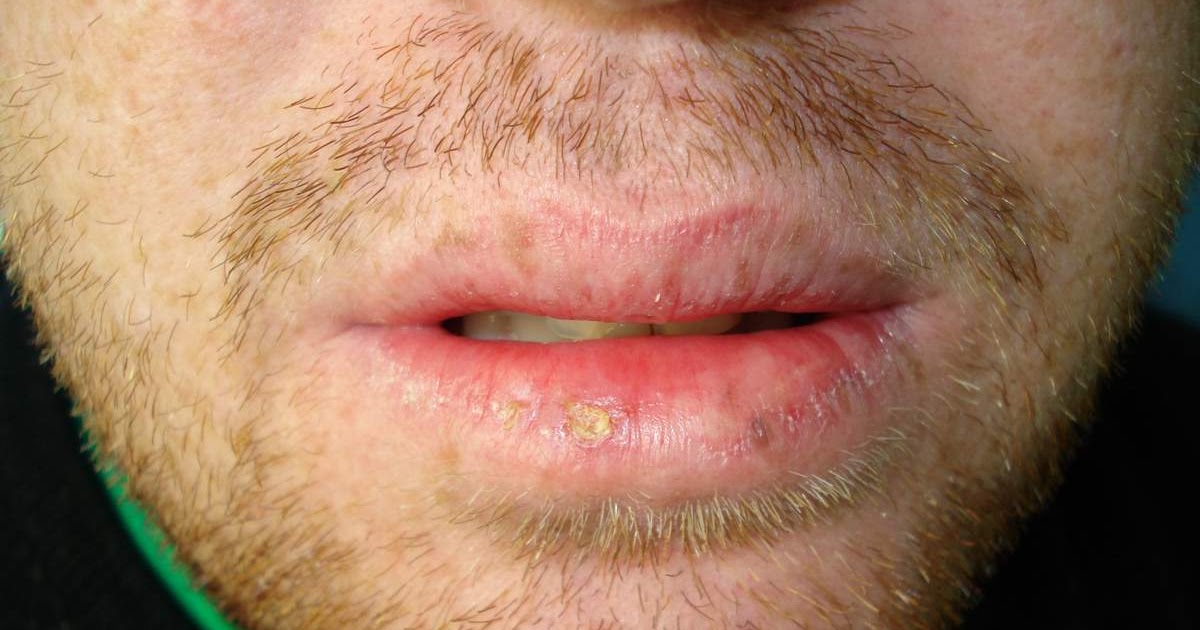 Skin Cancer College of ANZ Journal Updates: PDT and Actinic Cheilitis