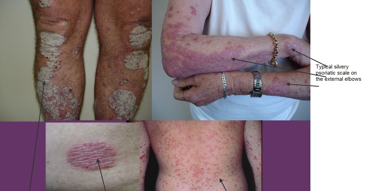 Atlas of Differential Diagnosis in Dermatology