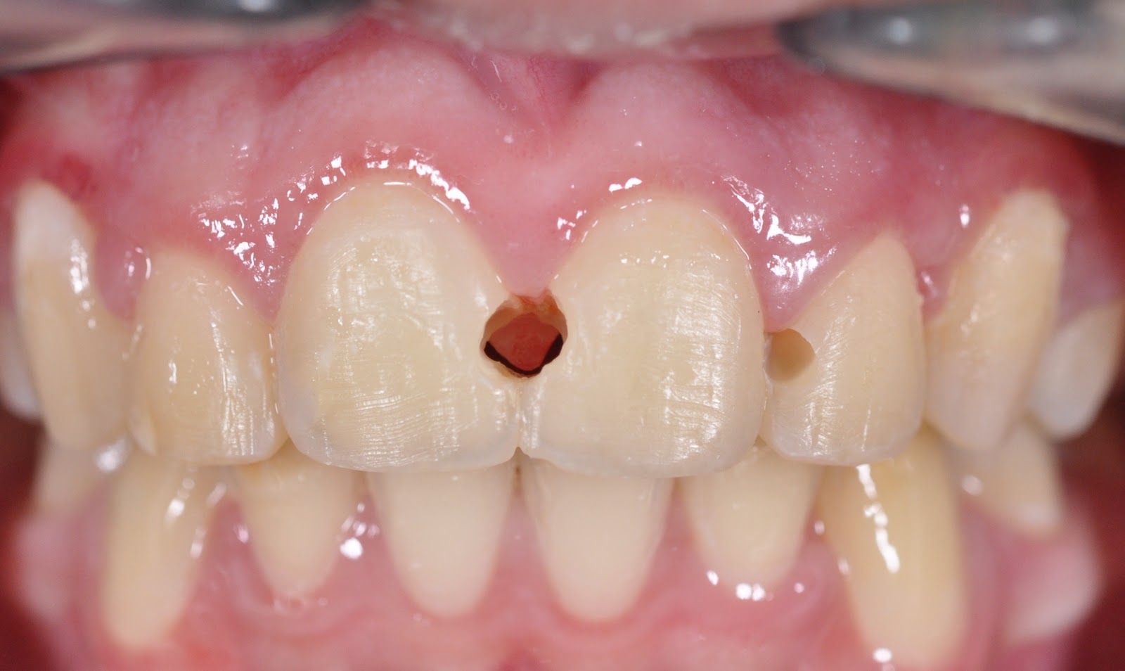 Odontología______________ Caries Interproximal