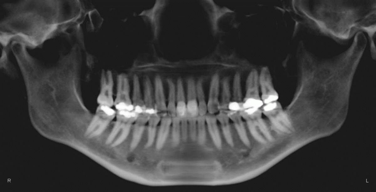 My Orthognathic Journey: X-ray Panoramic