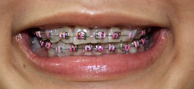 First time braces