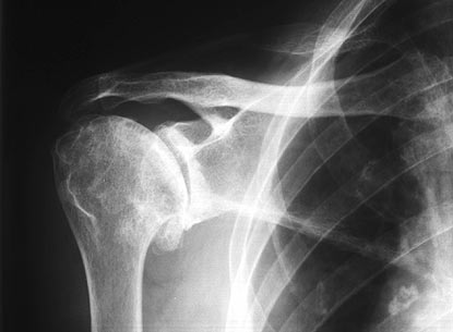 [ARTROSIS%20DE%20HOMBRO-RADIOGRAFIA.jpg]