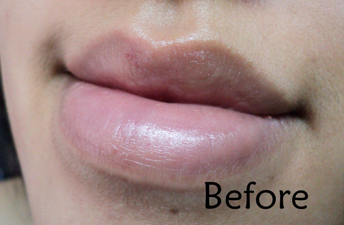 Dry White Patch On Lip
