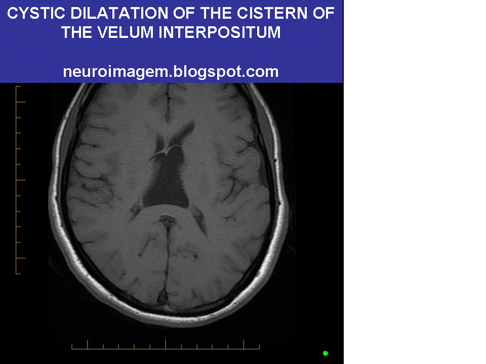 Cavum Velum Interpositum Cyst