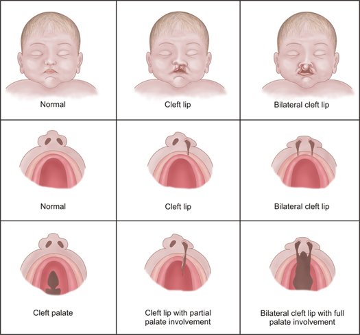 Cleft Chart