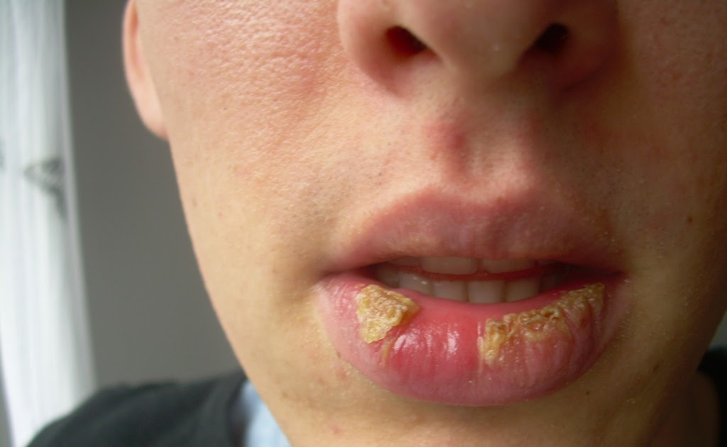 Exfoliative Cheilitis Blog Back to Lip Balm Day 19