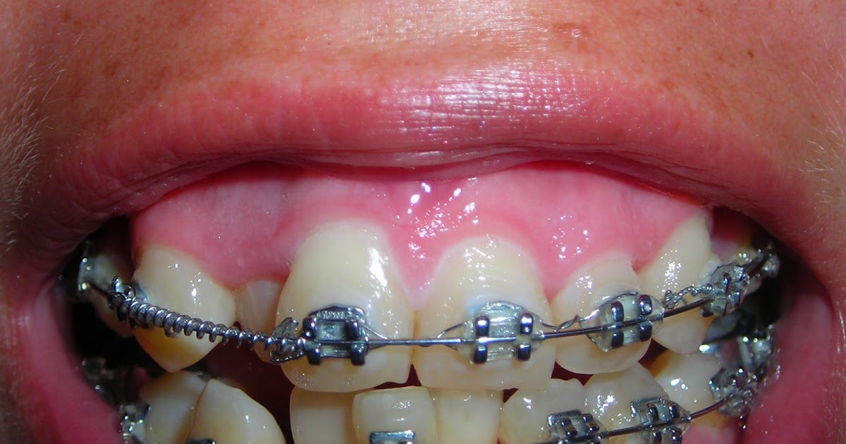 Mi Ortodoncia, mi cambio Un resorte!!!!