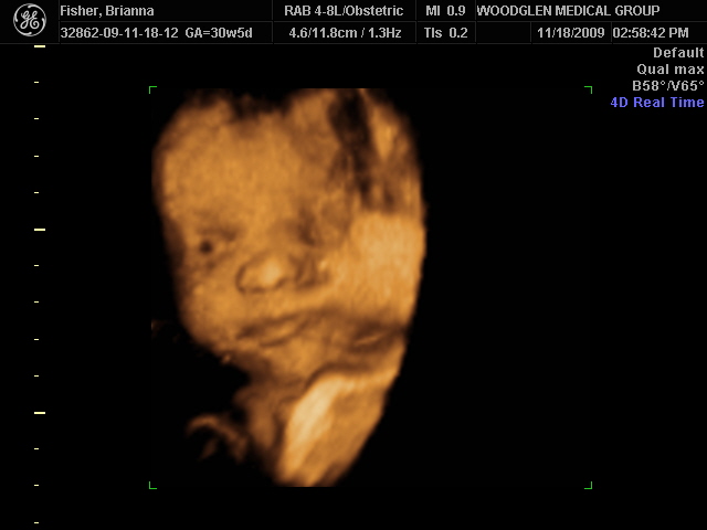 New 3D Ultrasound pictures and