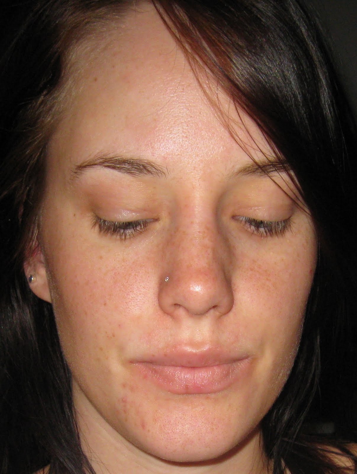 Chin Pores