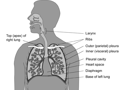 I have pleurisy.