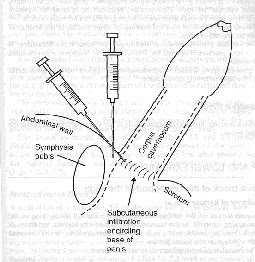 anaesthesia.com: Penile block; field block for circumcision