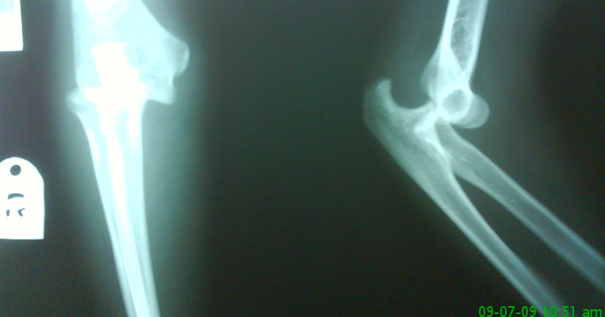 Elbow injury case study picture