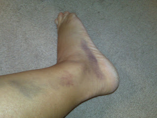 Rolled Ankle Bruising Spreading