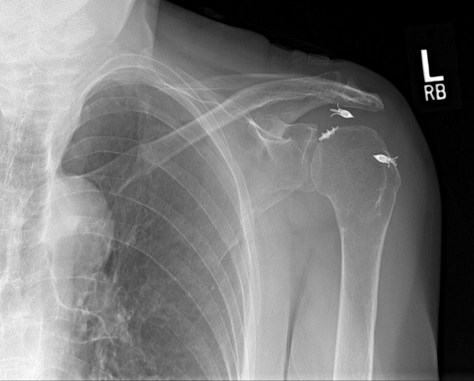 Interesting Shoulder Xrays James Mazzara MD Shoulder Knee Elbow