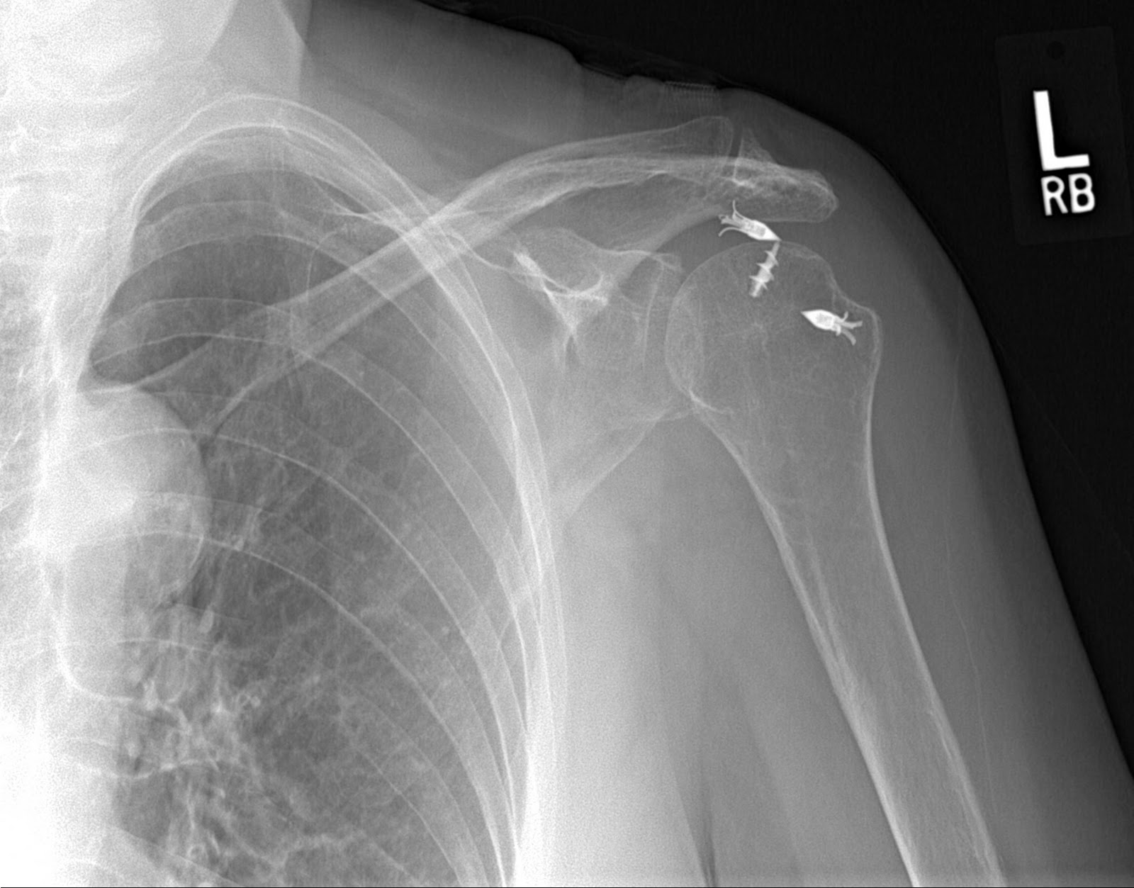 Interesting Shoulder Xrays James Mazzara MD Shoulder Knee Elbow