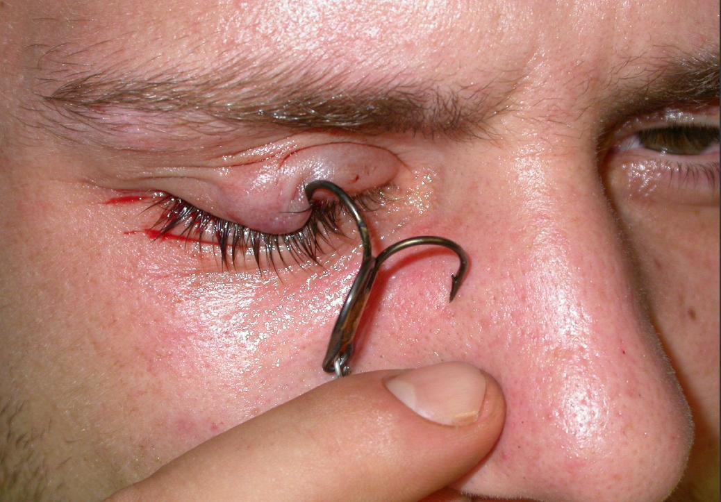 Fish Hook Injuries