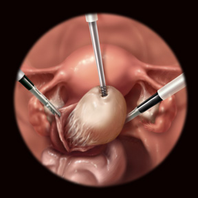 [Lap_MyomectomyRemoval.jpg]