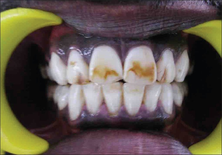 Fluoride Dangers Treatment for Dental Fluorosis
