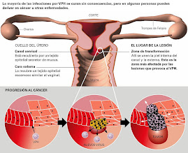 PROGRESIÓN DEL VPH