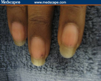 Nevus at the nail base; Breast cancer; Melanoma (check for periungal