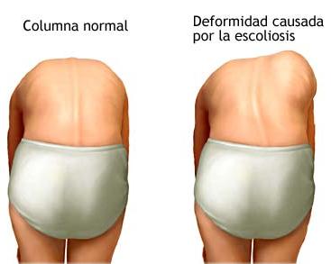 Zaschemlenie del nervio en la columna vertebral los síntomas el tratamiento