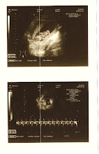 12th Week Ultrasound with heartbeat