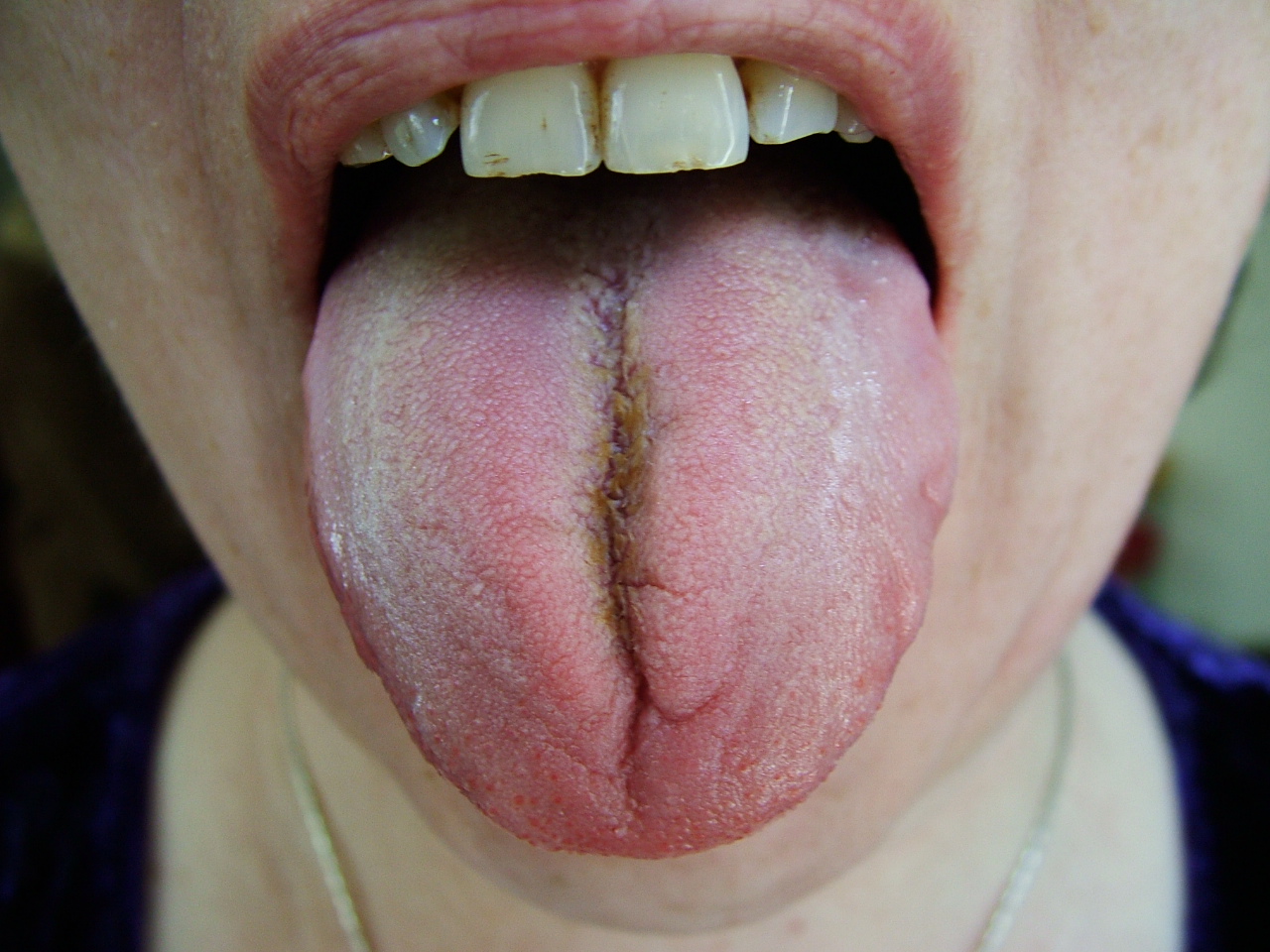 manchas cafes en la punta de la lengua