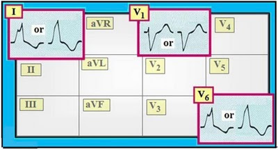 wide complex ivcd wide complex ivcd