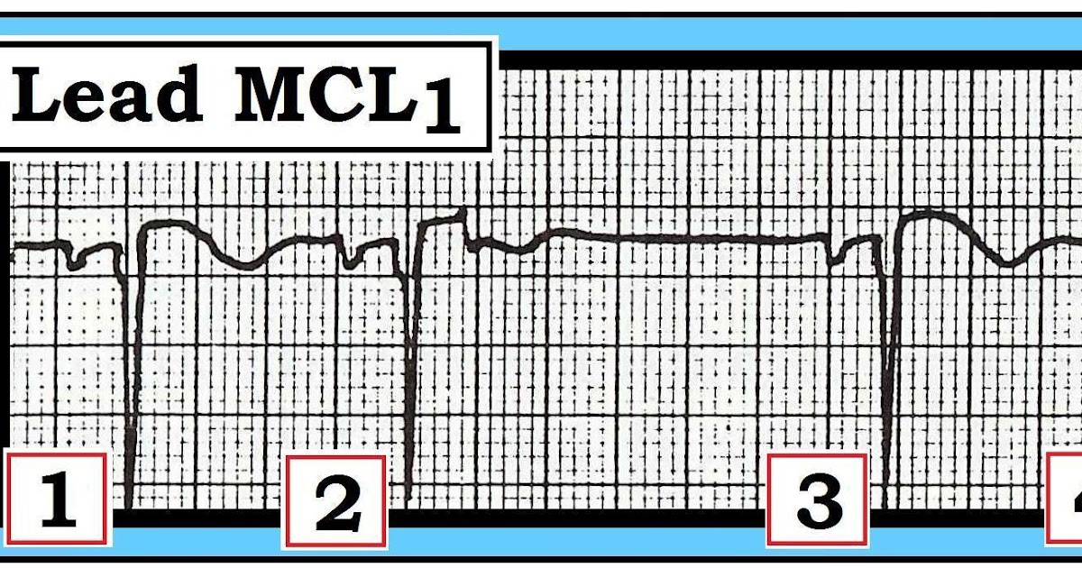 ECG Interpretation ECG Interpretation Review 14 (Pause AV Block vs