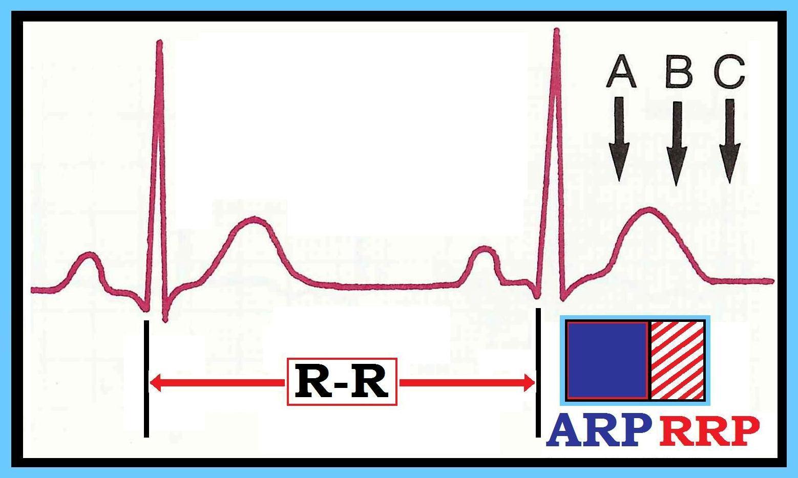 Pac Ekg Strip