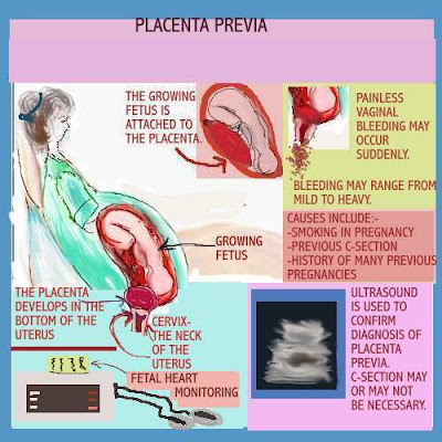 nursing: Nursing Care Plan | NCP Placenta Previa