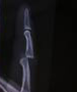 Finger Dislocated