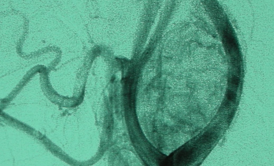 ANGIOLOGIA Y CIRUGIA VASCULAR Y ENDOVASCULAR GLOMUS CAROTIDEO