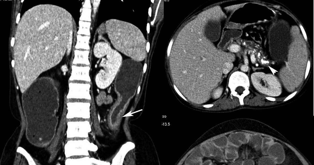 Radiodiagnosis - Imaging is Amazing-Interesting cases: Crohn's disease
