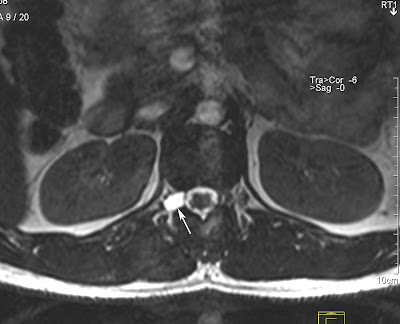 tarlov cyst