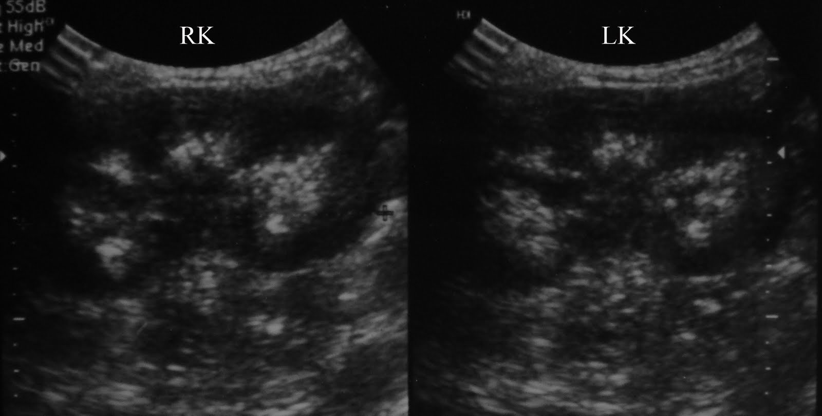 Radiodiagnosis Imaging is AmazingInteresting cases Medullary