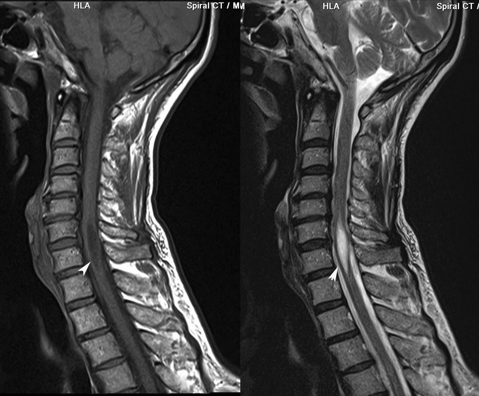 Arachnoiditis Mri