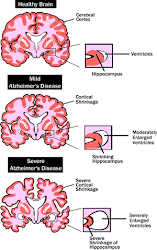 How the brain looks when attacked by Alzheimer's disease!