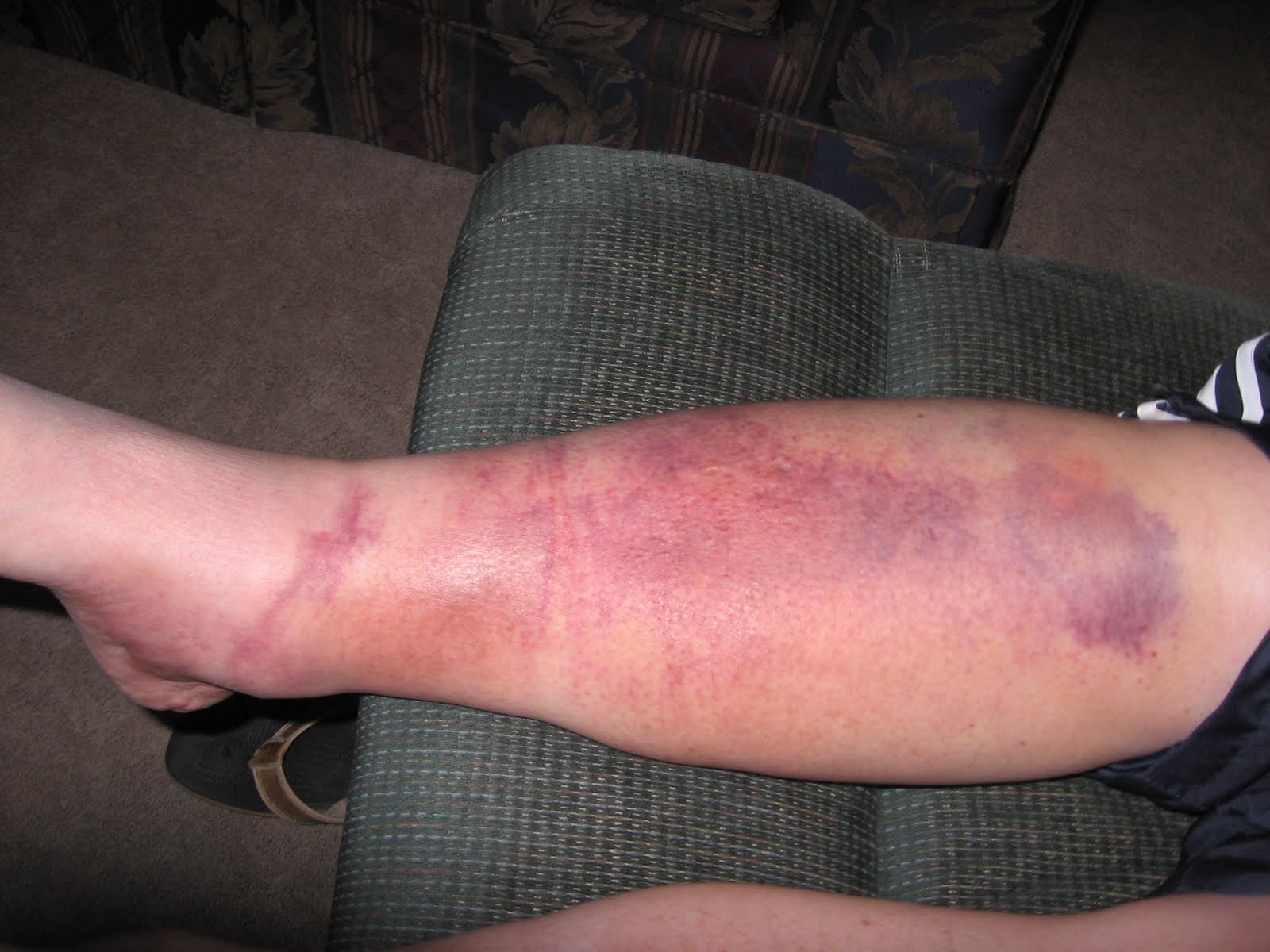 Bruised Leg 76