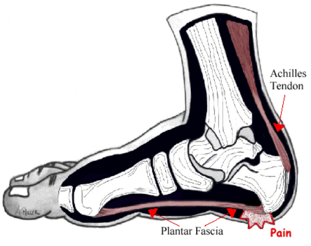 Painful Heel