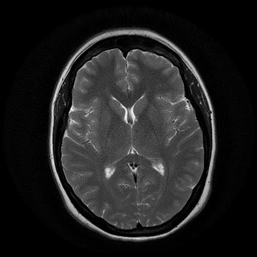 Radiology Cases Idiopathic Intracranial Hyertension