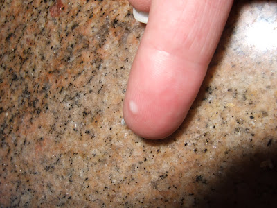 flat wart hand